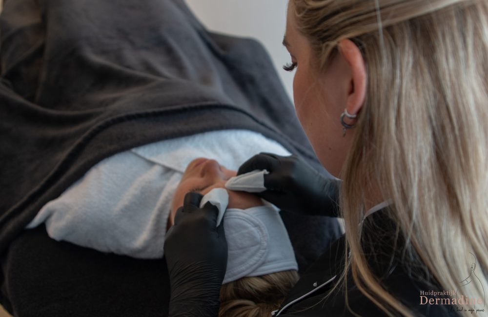 Acnetherapie bij Huidpraktijk Dermadine in Barendrecht